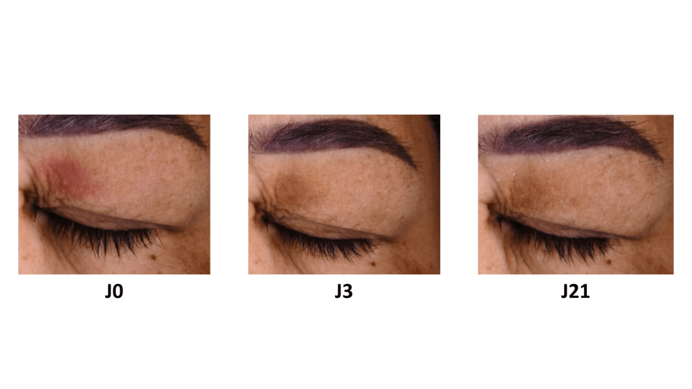 Avant/Après PALPEBRAL