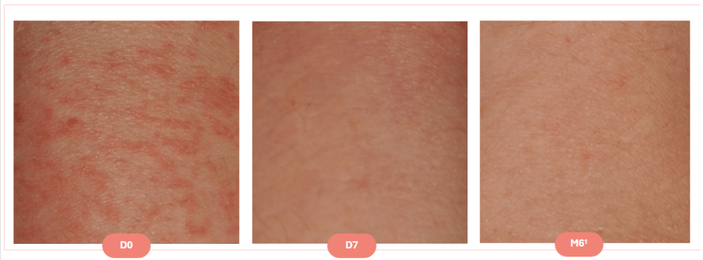 Photo avant/ après baume relipidant XERACALM AD