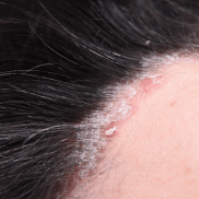 du_kertylol-pso_silo_psoriasis_areas_l3_pso-hair-scalp