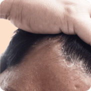 Dermatite Séborrhéique