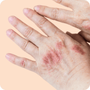 Eczema