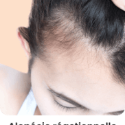 Alopécie réactionnelle