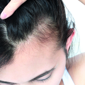 ALOPECIE AIGUE