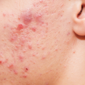 AVENE_ACNE_SEVERE