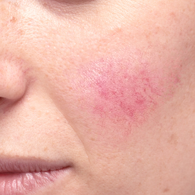 av_peaux-sensibles_acne_rosacee_1x1