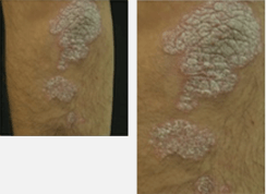 Efficacité de KERTYOL PSO baume J1