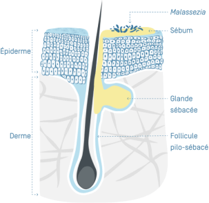 Dermite Séborrhéique - 02