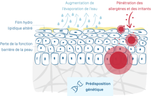 Eczéma Atopique - 02