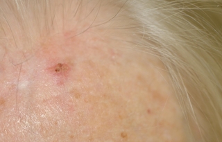 Keratose actinique 3