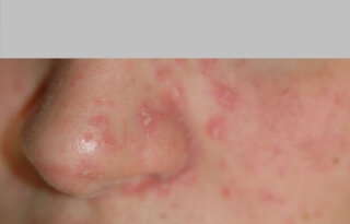 Sébo-psoriasis-01.jpg