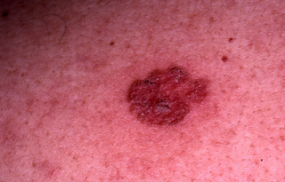 Superficial-basal-cell-carcinoma-BCC-01.jpg