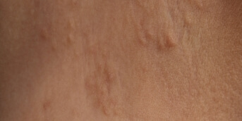 Dermatose polymorphe