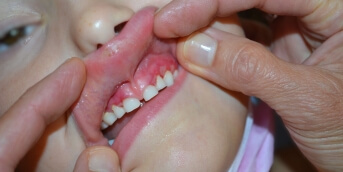 Gencives douloureuses  Ajouter une colonne