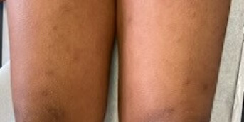 01Infiltration cutanée diffuse