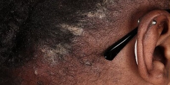 Dermatose pustulaire 1