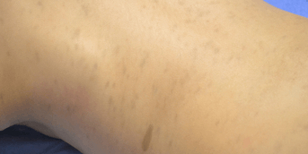 Cause rare d'hyperpigmentation chez l'enfant