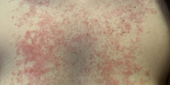  Dermatose inflammtoire du tronc ketorash 1