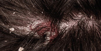 DERMITE SEBORRHEIQUE, Cards