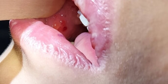 Des bulles muqueuses initiales