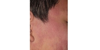 Kératose pilaire acquise (1)