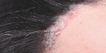 PSORIASIS, CARD