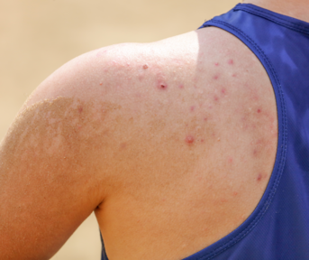 du_keracnyl_silo_acne_daily_l3_header_sport 