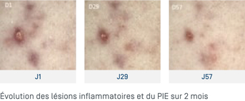 Keracnyl lésions