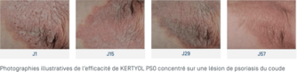 Kertyol PSO Concentré · Efficacité
