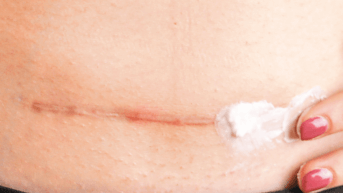 Photo cicatrisation, poster EADV