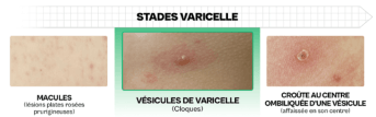 Les stades de la varicelle