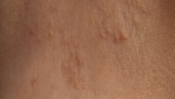 Dermatose polymorphe