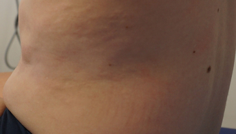 02Infiltration cutanée diffuse