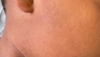 03Infiltration cutanée diffuse