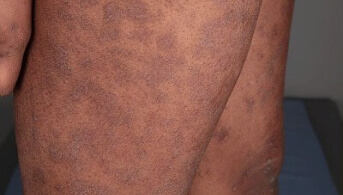 Dermatose pustulair 3