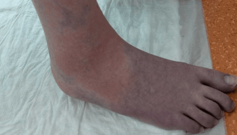Dermatose tricolore (1)