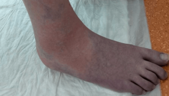 Dermatose tricolore, carrousel