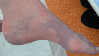 Dermatose tricolore (2)