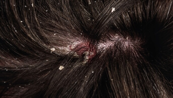 EADV 2025 - poster DS