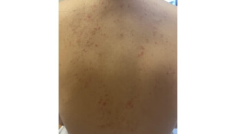 Keto Rash