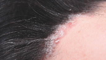 PSORIASIS, CARROUSEL
