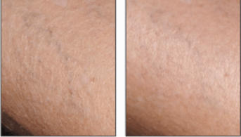 Sensinol Lait · Illustration Xerose