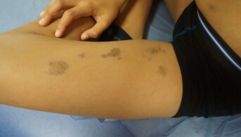 Une couleur gris bleue taches cuisse jeune.