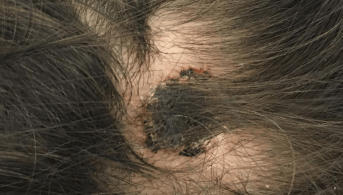alopecie