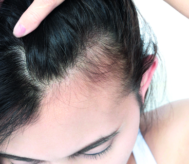 ALOPECIE AIGUE