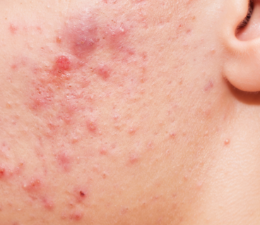 AVENE_ACNE_SEVERE
