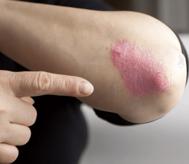 Comment soulager les démangeaisons causées par votre psoriasis en plaque ?