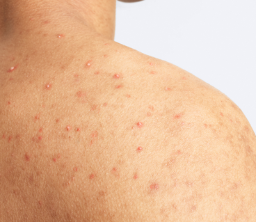 du_keracnyl_body spray_men_pathology_4x5_01.2026