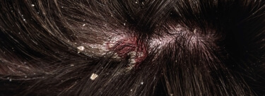 EADV 2025 - poster DS