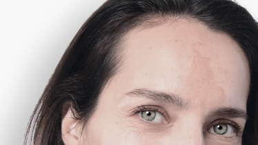 Pathologie Hyperpigmentation